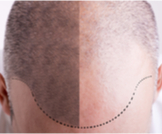 أنواع زراعة الشعر: تعرف عليها