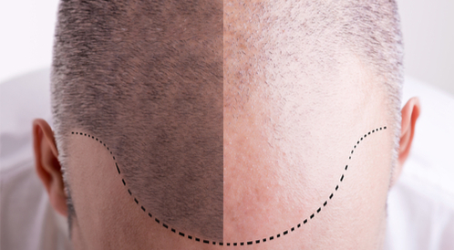تعليمات بعد زراعة الشعر