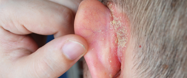 استرخاء متورط محيط شكل  أكزيما الأذن دليلك الشامل - ويب طب
