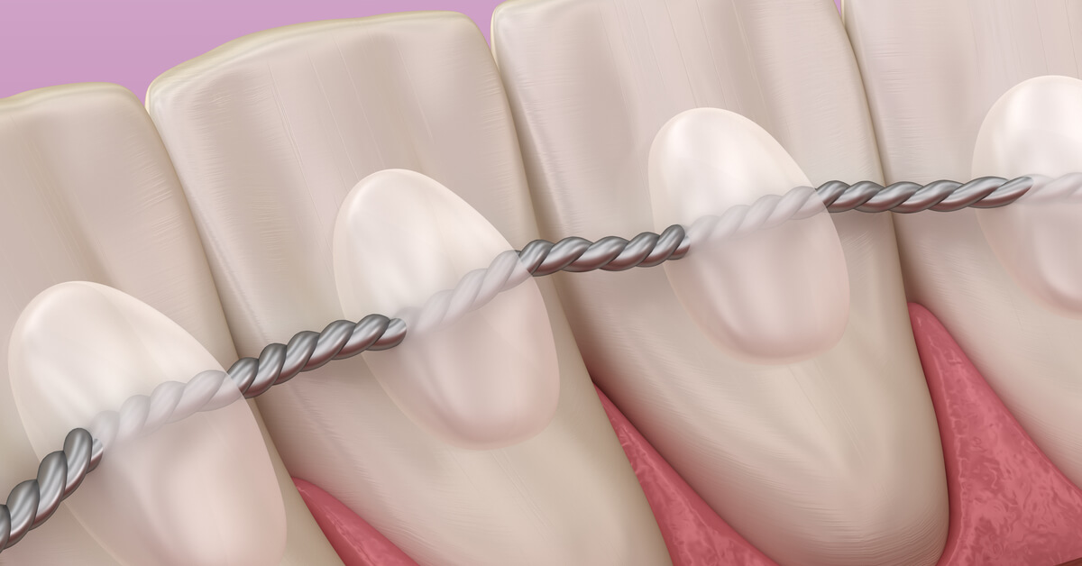 الأسنان الثابتة بعد تقويم الأسنان Web Medicine