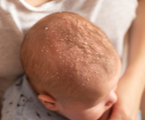 الأكزيما الدهنية عند الرضع