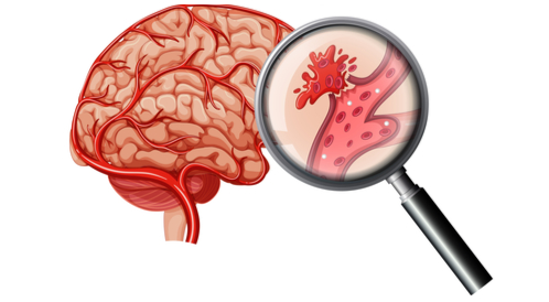 أنواع السكتة الدماغية النزفية وأعراضها ويب طب