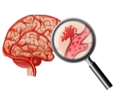 أنواع السكتة الدماغية النزفية وأعراضها