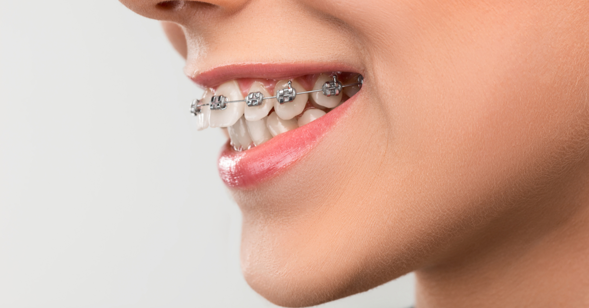 يصرف تركيز ميراث  علاج بروز الأسنان الأمامية - ويب طب