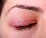 التهاب الجلد حول العين: أسباب وعلاجات مختلفة