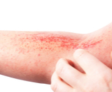 أنواع التهاب الجلد: عديدة وأبرزها الأكزيما