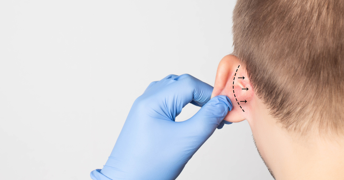 عملية تجميل الأذن: دليلك الشامل - ويب طب