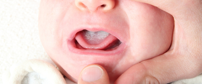 فطريات فم الرضيع: أبرز المعلومات - ويب طب