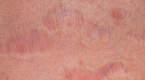 طرق علاج التشققات الحمراء: من الطب والطبيعة