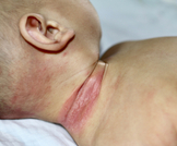 فطريات الجلد عند الرضع