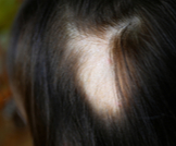 الثعلبة البقعية: مرض يسبب تساقط الشعر