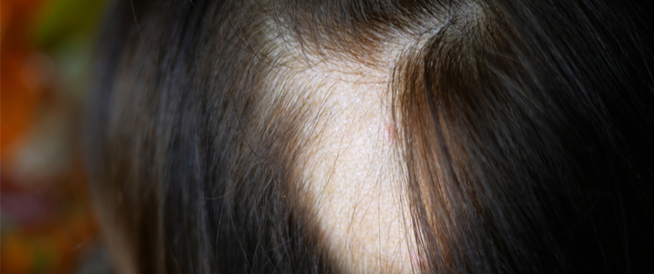 معتوه دستور الخريف  الثعلبة البقعية: مرض يسبب تساقط الشعر - ويب طب