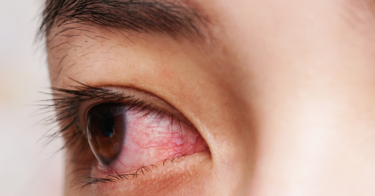 أسباب احمرار العين عند الاستيقاظ - ويب طب