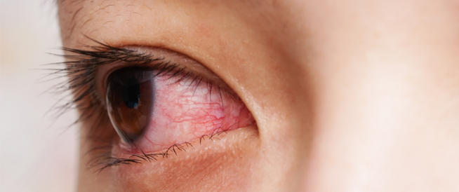 أسباب احمرار العين عند الاستيقاظ ويب طب