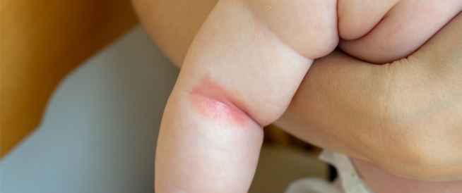 صدفية الثنيات: صدفية تصيب طيات الجسم