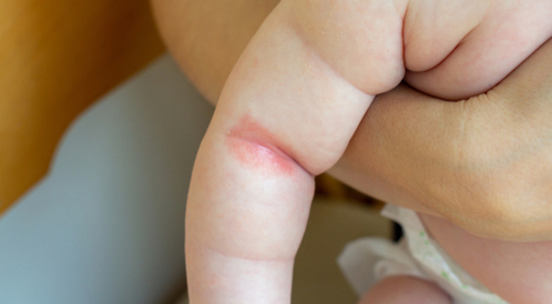 صدفية الثنيات: صدفية تصيب طيات الجسم