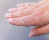 علاج جفاف اليدين وتشققها