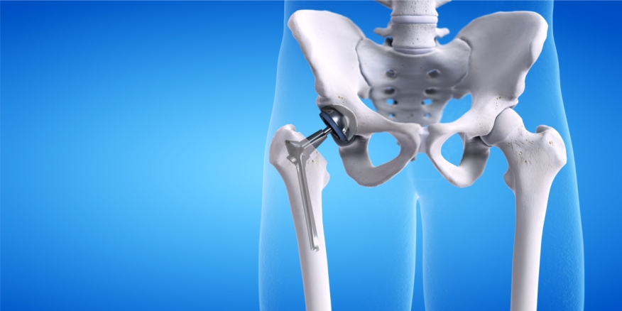 What are the reasons for replacing the hip joint with an artificial one?