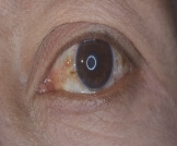 اللطخة الصفراء في العين: أسباب وعلاجات