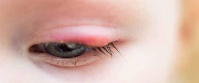 علاج انتفاخ جفن العين العلوي عند الأطفال - ويب طب