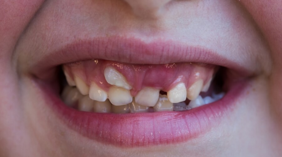 أي واحد القمر وسيط  ظهور الاسنان الدائمة قبل سقوط اللبنية - ويب طب