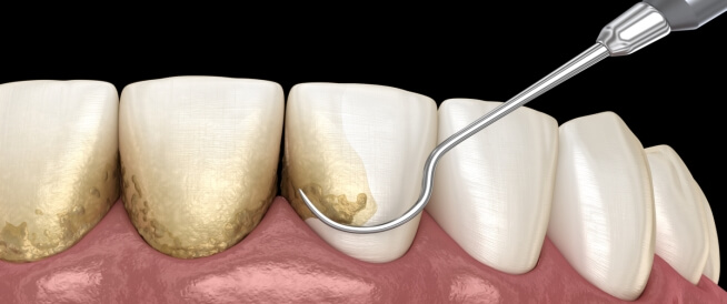 التهاب دواعم السن: من أمراض اللثة التي قد تفقدك أسنانك