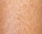 جفاف الجلد المصطبغ: دليلك الشامل
