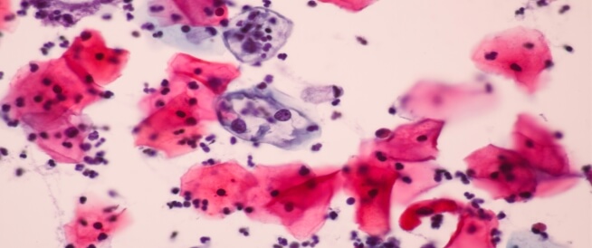 خلايا غريبة في عنق الرحم: معلومات تهمّك