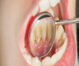 أضرار جير الأسنان: عديدة، بعضها قد يفاجئك