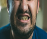 تصبغات الأسنان السوداء: أسباب عديدة