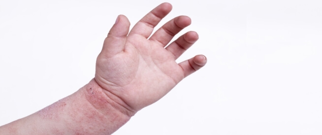 تشققات الجلد عند الأطفال: أسباب وعلاجات