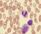 التليف النقوي: نوع نادر من سرطانات الدم