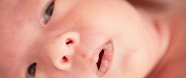 الجفاف عند الرضع: أعراض وعلاجات