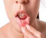 علاج تقرحات الفم بالملح: هل هو ممكن؟