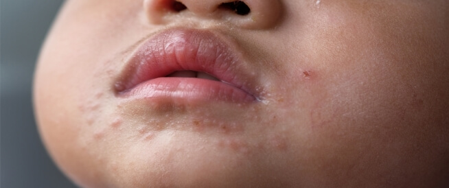 للتفاعل معتاد مدرس  التهاب الجلد حول الفم عند الرضع - ويب طب