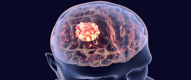 أعراض سرطان الدماغ في مراحله الأولى وطرق التشخيص