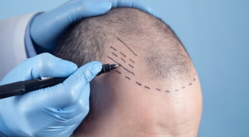 مخاطر زراعة الشعر: تعرف عليها