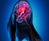 أعراض الجلطة الدماغية عند الشباب وطرق التشخيص