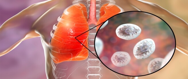 التهاب الرئة الفطري: معلومات تهمك