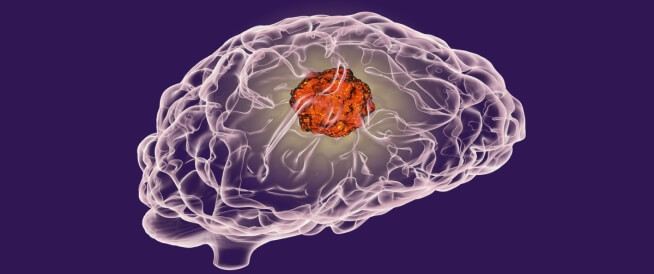 علاج أورام المخ بدون جراحة: هل هو ممكن؟