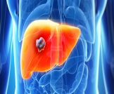 مراحل سرطان الكبد