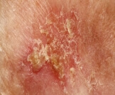 مرض بوين: مرحلة مبكرة من سرطان الجلد