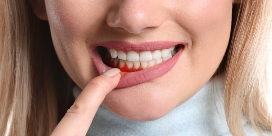 أمراض اللثة الخطيرة - ويب طب