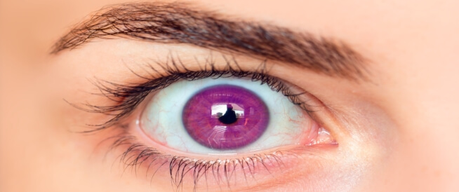متلازمة الإسكندرية (العيون البنفسجية): مرض حقيقي؟