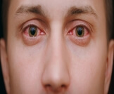 علاج التهاب العين الفيروسي