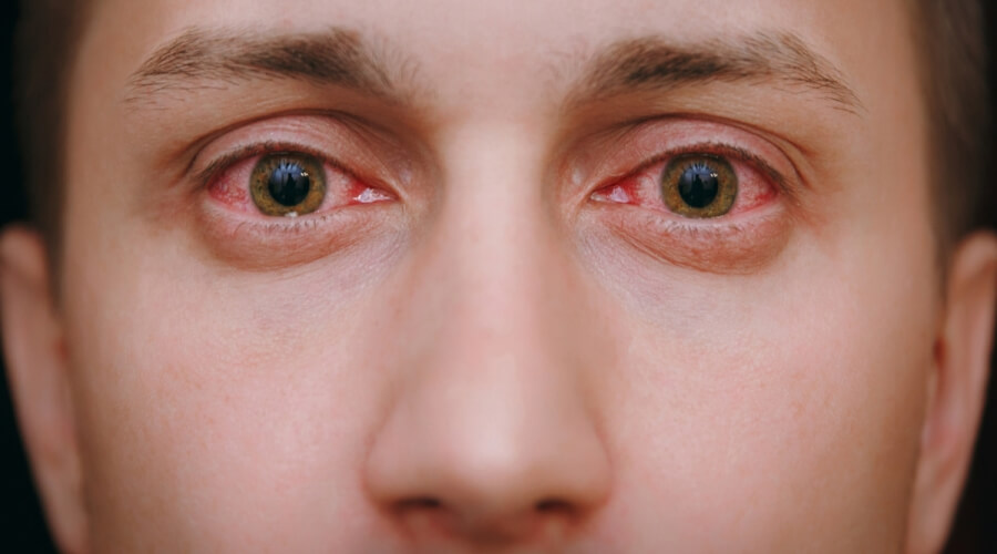 علاج التهاب العين الفيروسي - ويب طب