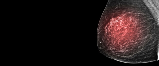 أعراض سرطان الثدي الحميد