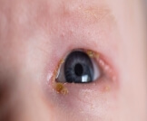 علاج عماص العين عند الرضع