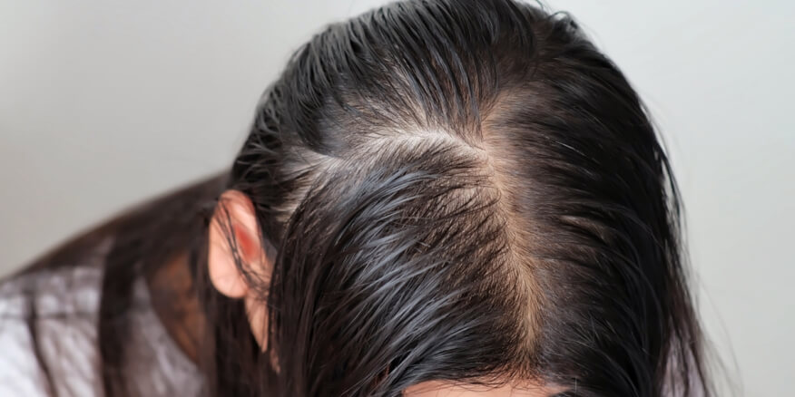 علاج فراغات الشعر الأمامية للنساء - ويب طب