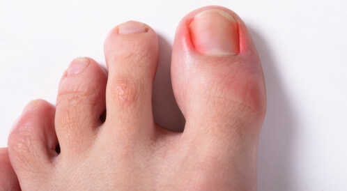 حرارة في أصابع القدم: ما سببها؟